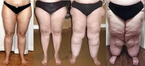 O que é Lipedema