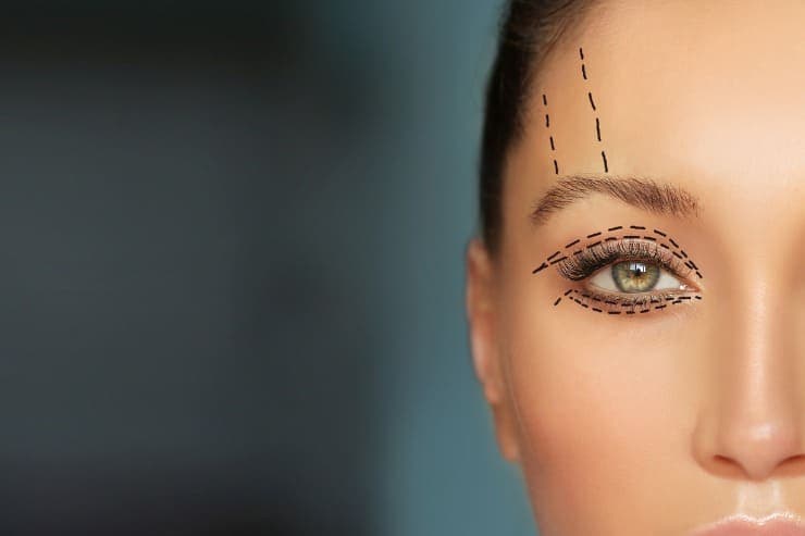 como funciona a blefaroplastia inferior