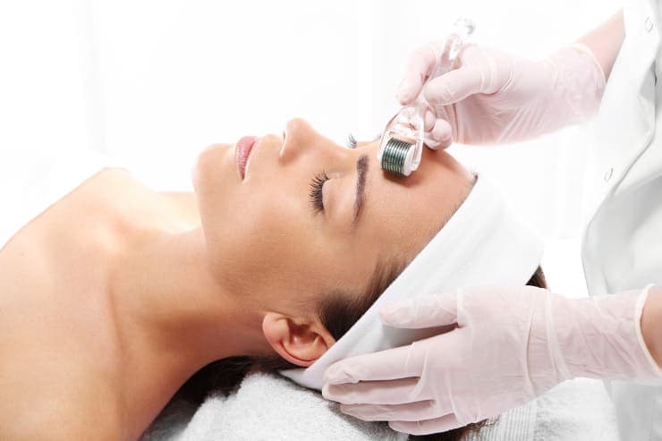microagulhamento para marcas de acne