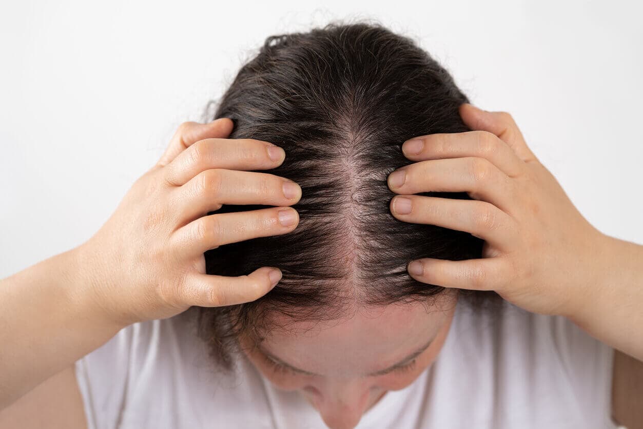 Pessoa com queda de cabelo aparente na região central do couro cabeludo, afastando os fios para mostrar sinais de calvície genética.